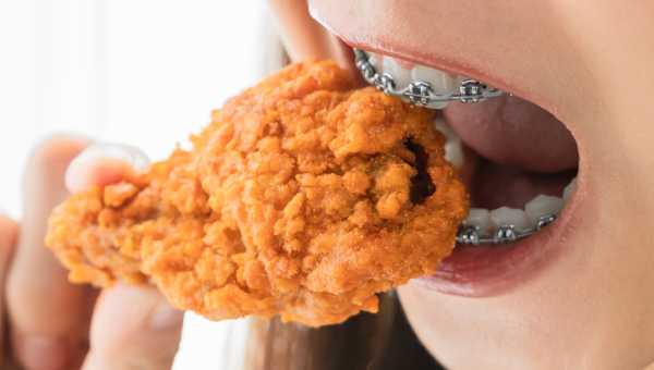 Foods to Avoid With Houston Braces