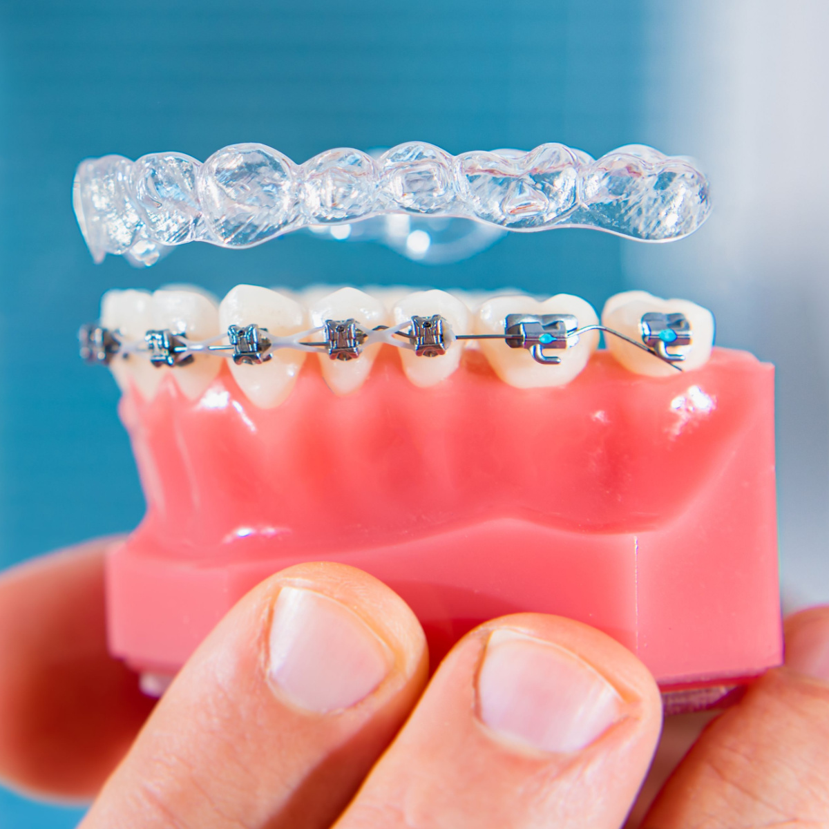 A Comprehensive Guide to Different Types of Houston Braces
