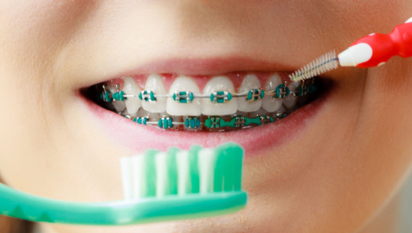 The Importance of Proper Hygiene and Dental Check-Ups When Wearing South Houston Braces