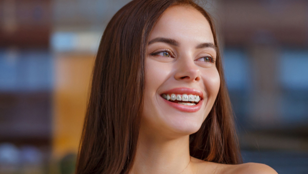 Getting South Houston Braces: What to Expect the First Month
