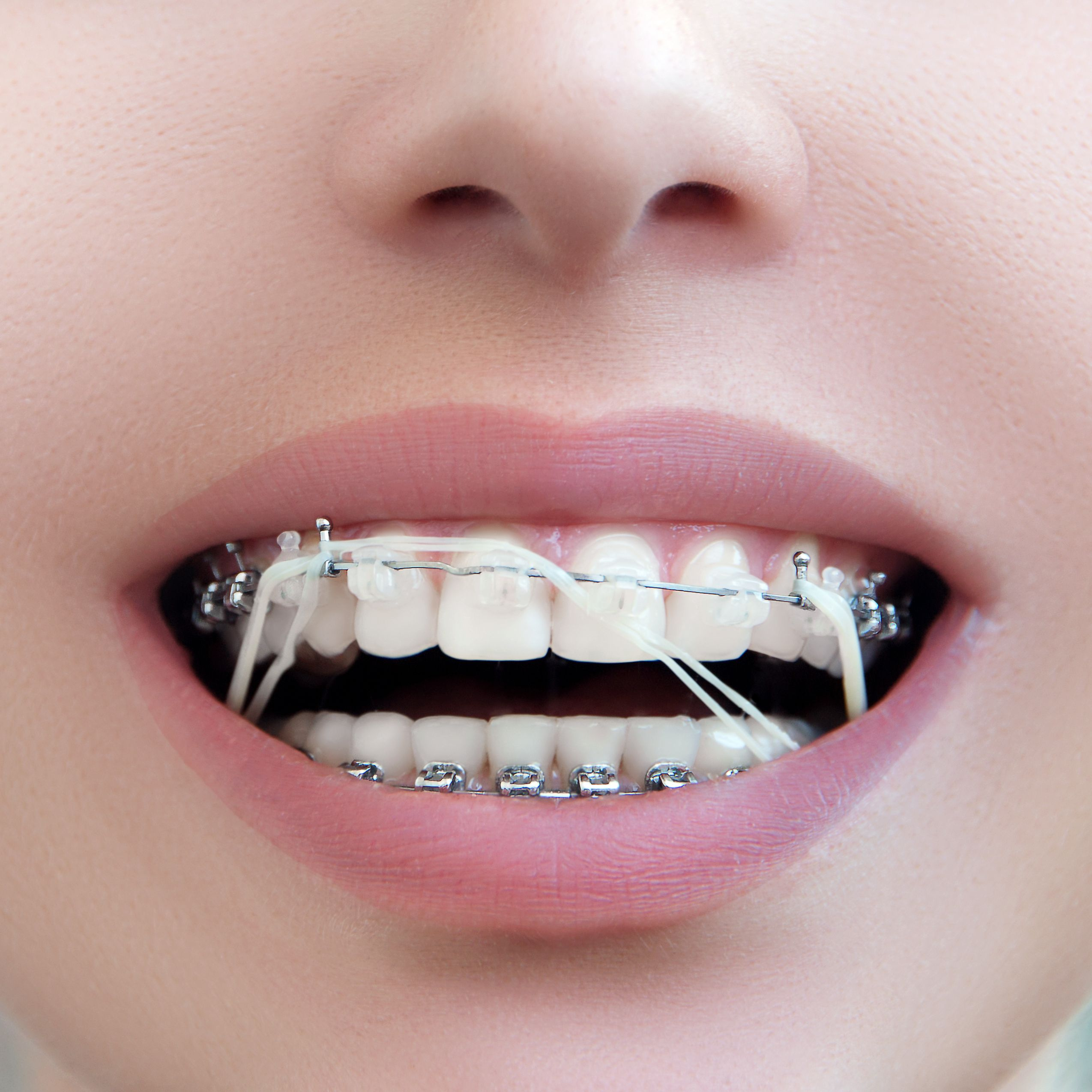 When Do South Houston Braces Patients Have to Wear Rubber Bands?