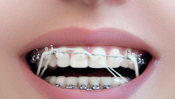 When Do South Houston Braces Patients Have to Wear Rubber Bands?