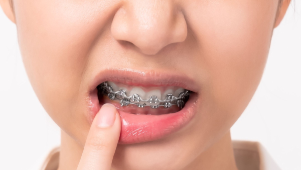 How to Manage ﻿Houston Braces Pain