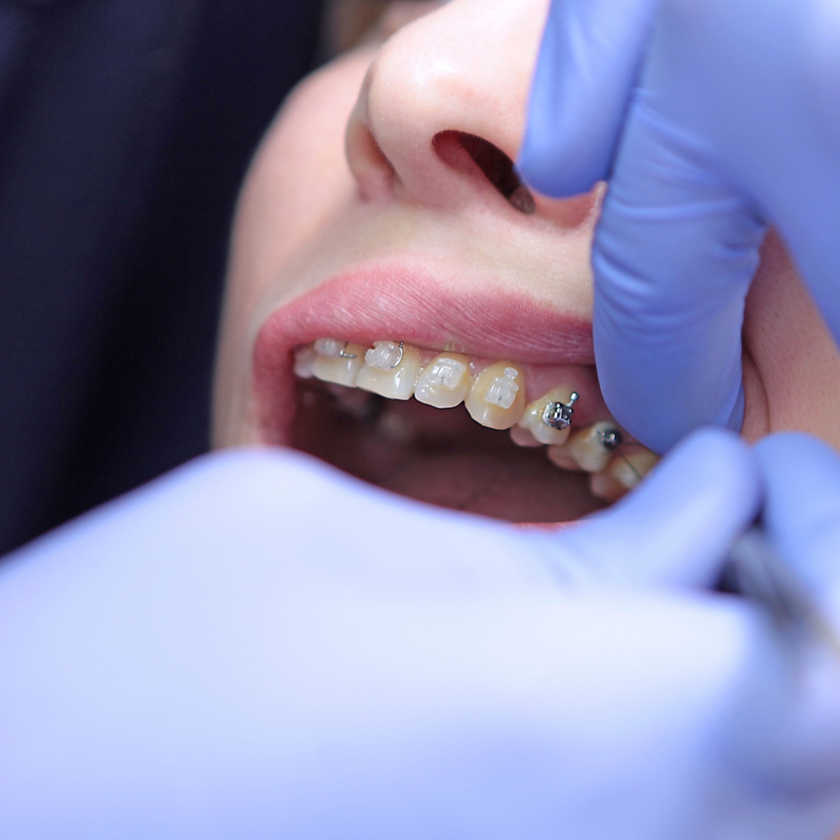 What Type of Houston Braces Is Best for You?
