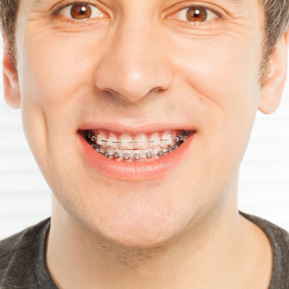 How to choose between ceramic or metal South Houston braces
