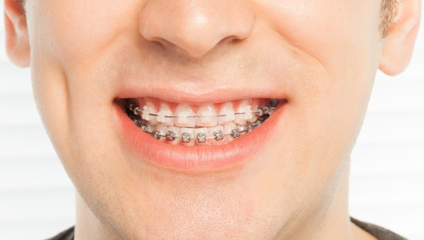 The Pros and Cons of Ceramic vs Metal South Houston Braces