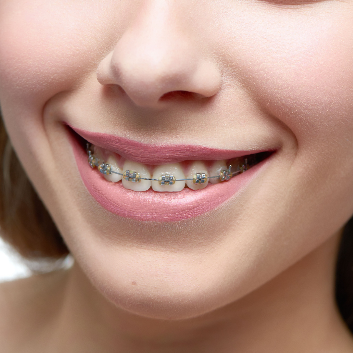 Use these tips to care for your South Houston braces.