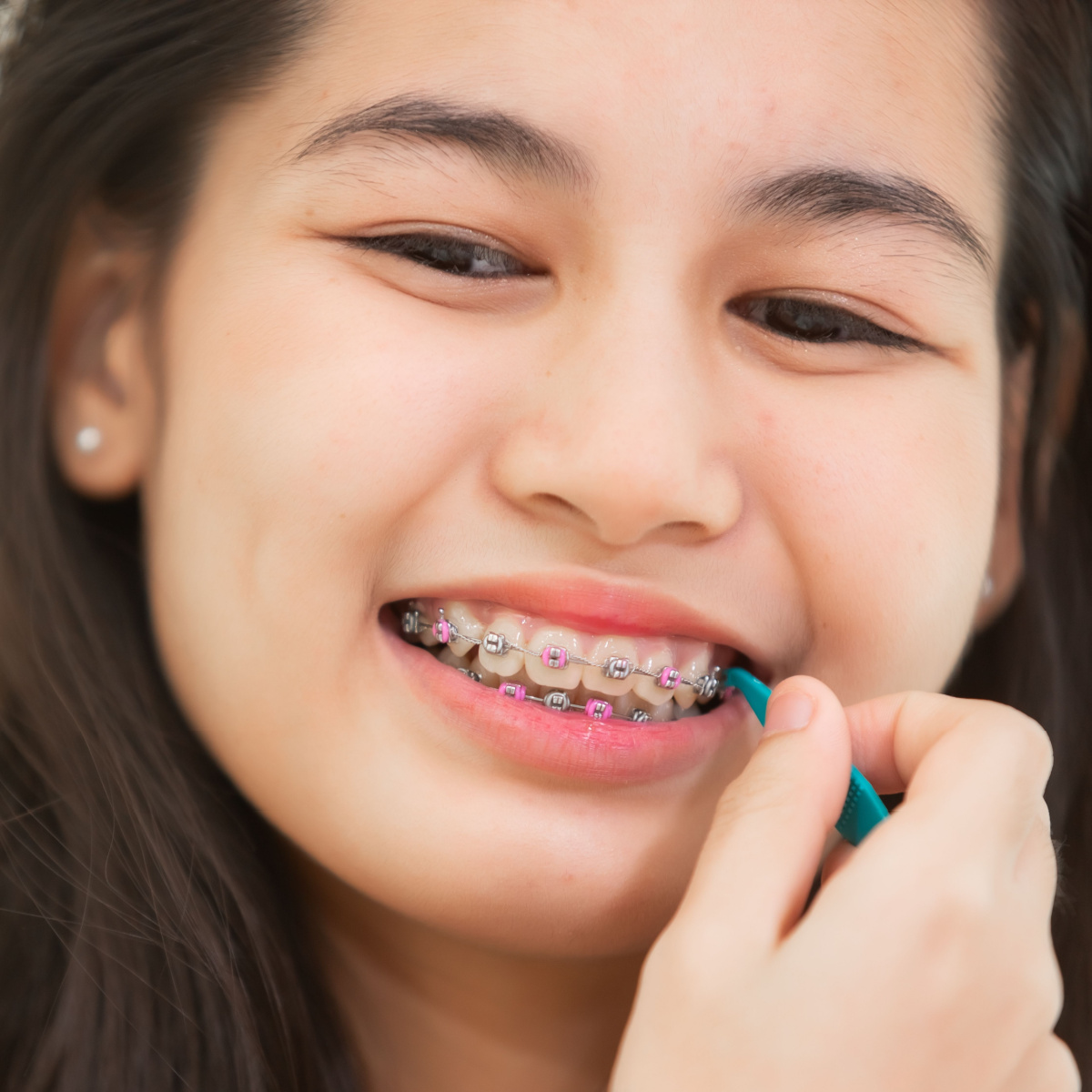 Develop these hygiene habits to keep your South Houston braces in perfect condition.