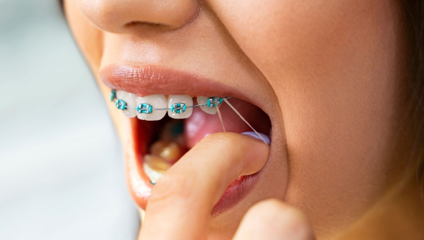 Why Wearing Your Elastics With Houston Braces Is a Must