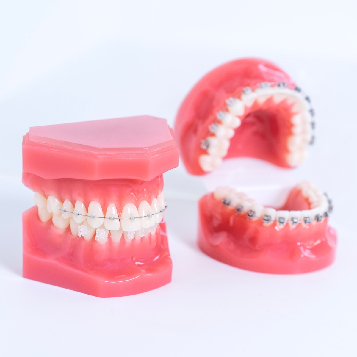 Invisalign vs Ceramic or Metal South Houston Braces: Which Is Better for You?