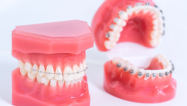 Invisalign vs Ceramic or Metal South Houston Braces: Which Is Better for You?